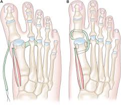 Image result for Hallux Varus