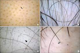 If so, give it a week and if it is hair, it will have a shaft associated with it Dermoscopic Features Of Alopecia Areata Yellow Dots A Arrow Download Scientific Diagram