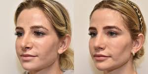 Amy K Hsu, MD, FACS, Board Certified Facial Plastic Surgeon