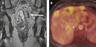 This screening test allows your doctor to carefully examine your colon for signs of polyps (abnormal growths on the inside surface of the colon that below, you can learn about the different types of screening tests for colorectal cancer. Imaging Of Colorectal Cancer The Clue To Individualized Treatment