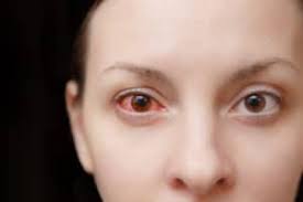 Image result for Eye Pain without Redness