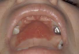 Image result for Oral thrush roof of mouth