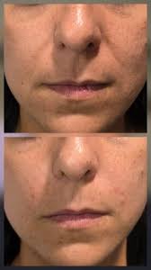 Neuramis Volume Lidocaine