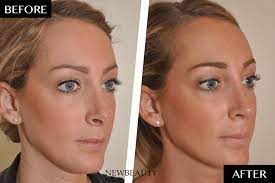 This is especially important when it comes to restoring the overall balance and symmetry of your face. Why Secondary Nose Jobs Are So Common Newbeauty
