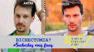 Bichectomia cirurgia angelina jolie bochechas antes depois beleza reduz famosas diminuir velhice quais consequencias dessa vogue. Bichectomia Procedimento Rapido E Facil Para Bochechas Mais Finas Youtube