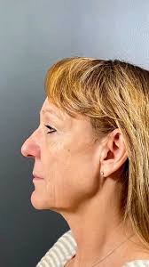 We are so excited to share the incredible transformation of one of our  amazing guests! 🌟 She underwent a facelift, neck lift, facial fat  transfer, and upper lip lift, all to enhance her natural beauty ...