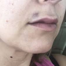 250 cetronia rd, ste 301, allentown, pa 18104. Kevitch Chung Jan Aesthetic Surgery Associates Cosmetic Surgeons 250 Cetronia Rd Allentown Pa Phone Number Yelp
