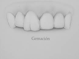 Resultado de imagen para gemacion dentaria