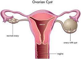 Kalau kita perhatikan di zaman teknologi ini semakin banyak bagian perut memang sangat mudah untuk melar. Perut Buncit Macam Wanita Mengandung Kedua Dua Ovari Rahim Dibuang Berpunca Ketulan Cyst Merbahaya Mingguan Wanita