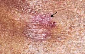 Image result for Dermatofibrosarcoma Protuberans