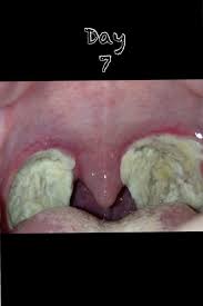 Tonsillectomy Scabs Fall Off Recovery Food Tonsil Removal Recovery Tonsillectomy Recovery