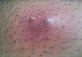 After a while it didnt hurt anymore and it just appeared to be an elongated pimple. Ingrown Hair How To Remove Ingrown Hair On Testicles
