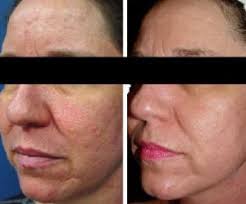 Fractionated Laser Skin Resurfacing