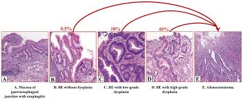 Histopathologic Features Of The Natural History Of Barretts Esophagus Be Progressive Transition From Squamous Epithelium To Intestinal Metaplasia