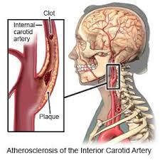 Balloon angioplasty appears to be just as good as surgery to unblock carotid arteries. Carotid Artery Disease What You Need To Know