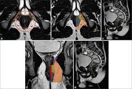 Magnetic Resonance Imaging of the Anal Region: Clinical Applications -  Journal of Clinical Imaging Science