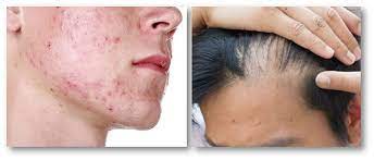 Clen does not produce deeper or hoarse voices, increased body hair, or unpredictable mood swings. Clenbuterol Side Effects Is There A Safe Alternative Crazy Bulk