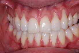Gum Recession In Children Pediatric Dentistry In Connecticut