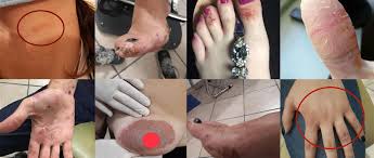 Gli alimenti che provocano intolleranza e allergia alimentare al nichel. Diagnosi E Cura Dell Allergia Al Nichel E Snas