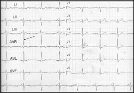 An ecg can provide clues about enlargement of the chambers or walls of. The Ecg In Diabetes Mellitus Circulation