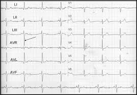 An ecg can provide clues about enlargement of the chambers or walls of. The Ecg In Diabetes Mellitus Circulation