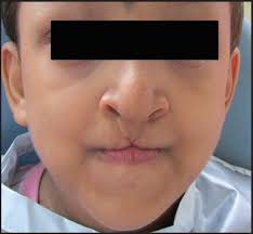 Ectrodactyly Ectodermal Dysplasia Cleft Lip And Palate Syndrome Dhar Rs Bora A J Indian Soc Pedod Prev Dent