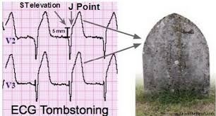 Image result for ST Elevation