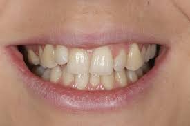 However, the treatment time is as little as six months. Invisalign What Are Invisalign Braces Teeth Straightening