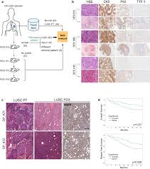 Lung tang international trading limited. Pdx Models Of Human Lung Squamous Cell Carcinoma Consideration Of Factors In Preclinical And Co Clinical Applications Journal Of Translational Medicine Full Text