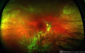 Image result for HIV Retinitis