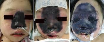 • other than hp bacterial infections: From The Pharynx To The Brain A Case Of Rapidly Progressing Mucormycosis Springerlink