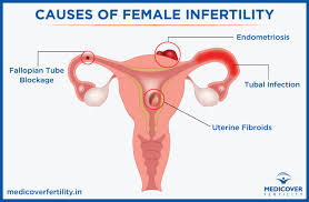 Female infertility has many possible causes, such as irregular ovulation, uterine fibroids, fallopian tube blockage, pcos, or endometriosis. Female Infertility Symptoms Causes Diagnosis Treatment