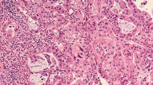 It's thought that pancreatic cancer can cause cells in the body to become resistant to insulin, a key hormone produced by the pancreas that helps regulate blood sugar levels. Abbvie S S Imbruvica Fails To Gain Traction In Pancreatic Cancer Biospace