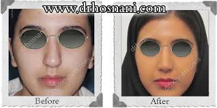 Deviated Nose Was Straightened And Made Narrower In The Tip By Nose Job Nose Job Rhinoplasty Thick Skin