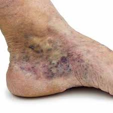 Image result for Stasis Dermatitis