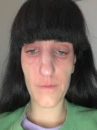 So it continues this was when I stepped out the shower so bizarre what's  causing this Sick of hiding 🌍🌍🌍👏😬it's spreading