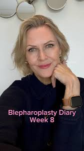 August 2024 😍, After 8 weeks, my upper blepharoplasty results have  improved and improved, so I’m delighted. Dr Joyce @cormacwjoyce told me the  full results occur around the 6 month mark but even so, ...