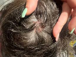 Image result for white scabs on the head in children