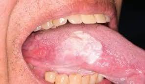 The bacteria build up on tiny rounded projections called papillae. Leukoplakia Causes Symptoms And Diagnosis Cards Dental
