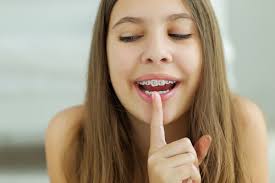 Get ready for a smile makeover! What Is The Average Price For Braces In Australia