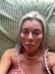 Face-lift & Neck-lift Support Group