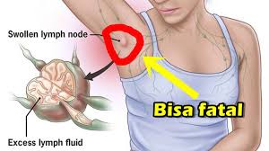 Pada peringkat ini, barah payudara sudah melibatkan nodus limfa ketiak, kulit ataupun otot yang terdapat di bawahnya (otot bahagian dada). Adakah Terdapat Ketulan Dalam Armpit Anda Berikut Adalah Beberapa Sebab