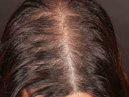 Recent studies have reported that menopausal hair loss occurs in more than 40 percent of cases. Alopecia Androgenetica In Women Altmeyers Encyclopedia Department Dermatology