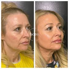 Angie Hayes — Bare. Medical Aesthetics