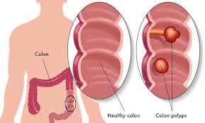 Với kỹ thuật này, một số dụng cụ nội soi được. Polyp Ä'áº¡i Trang La Bá»‡nh Gi 5 Triá»‡u Chá»©ng Va 3 Cach Ä'iá»u Trá»‹ Polyp Hiá»‡u Quáº£