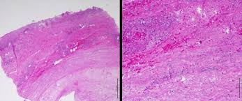 Controversy exists regarding both the underlying triggers of the disease and the type of treatment that should be. Histological Photomicrographs Of The Skin Lesion Representative Of Download Scientific Diagram