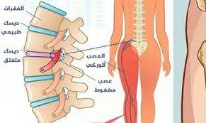 نصيحه من معافي بإذن الله من عرق النسا والانزلاق الغضروفي map