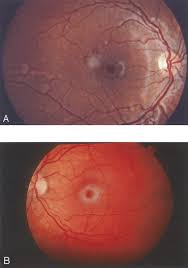 Inheritance autosomal recessive inheritance heterogeneous onset gard : Ocular Manifestations Of Niemann Pick Disease Type B Ophthalmology