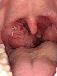 If you have an interest in white spots on tonsils and related queries; Is This Normal Looking Strep Throat Lots Of White Spots On Tonsils And Even On The Back Of My Throat Askmedical
