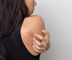 Image result for Papular urticaria